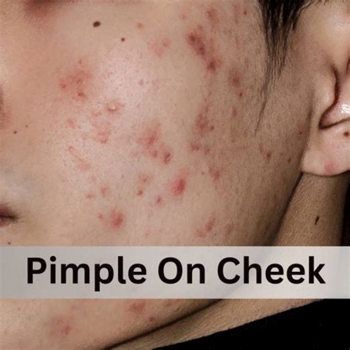 How do blemishes go away?