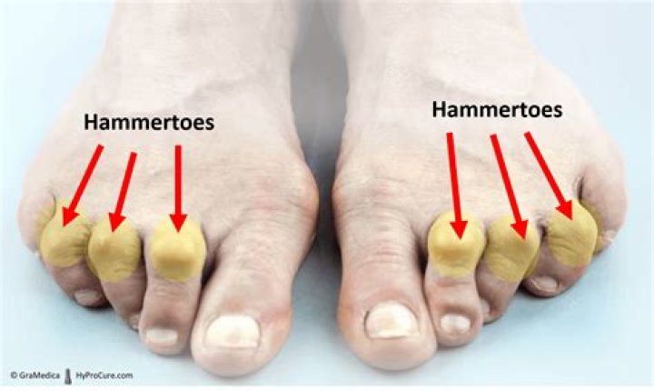 How do hammertoes form?
