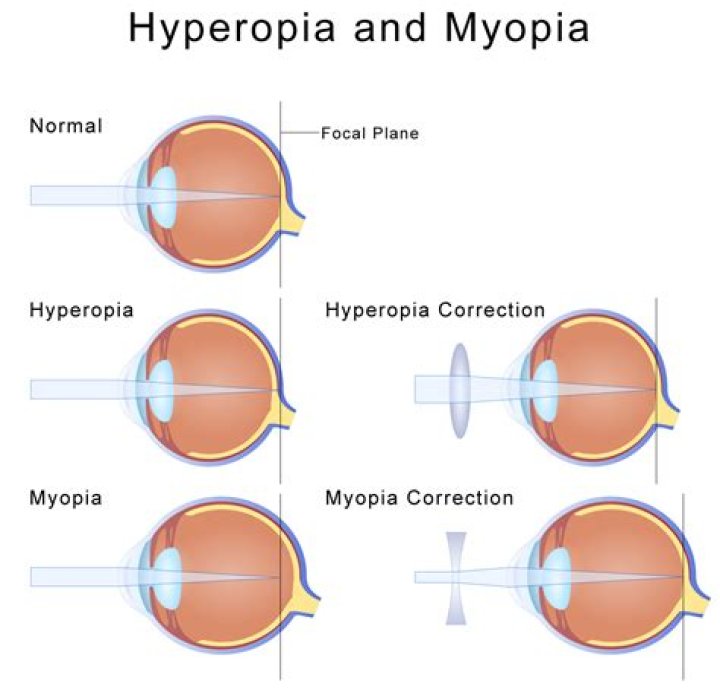 How do you correct presbyopia?