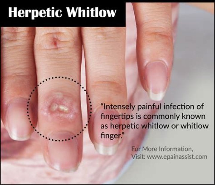 How do you get herpetic whitlow?