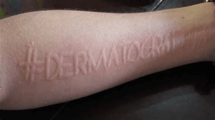 How do you get rid of dermatographia?