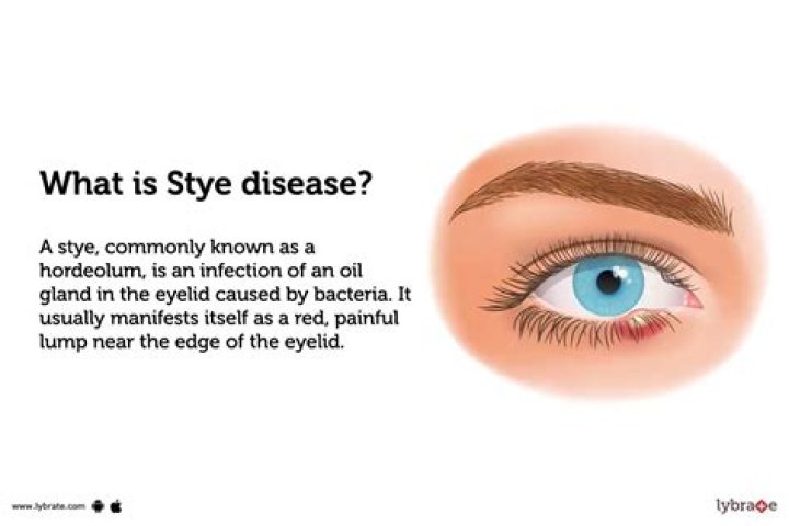 How do you get styes?