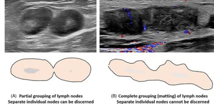 How do you treat a lymphocele lump?