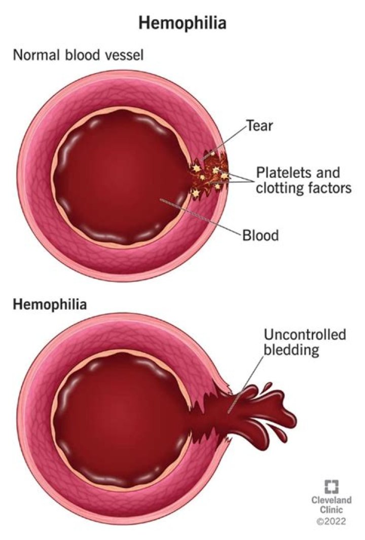 How haemophilia is caused?