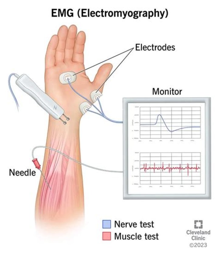 How is an electromyogram done?