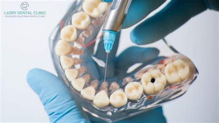 How is anesthesia given for wisdom teeth?