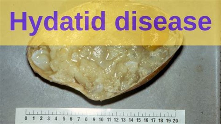 How is hydatid cyst diagnosis?