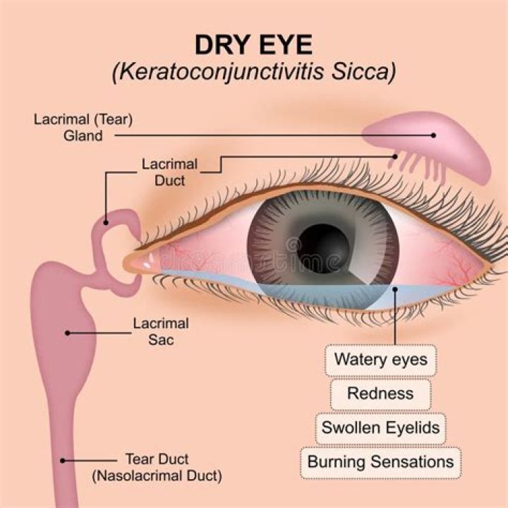 How is keratoconjunctivitis sicca caused?