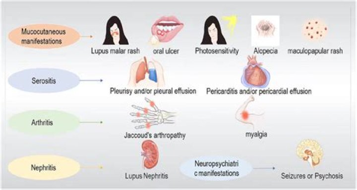 How is serositis causes?