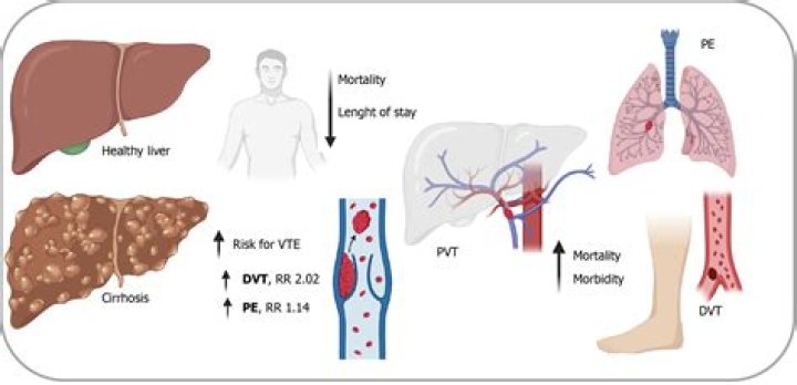 How is serositis treated?