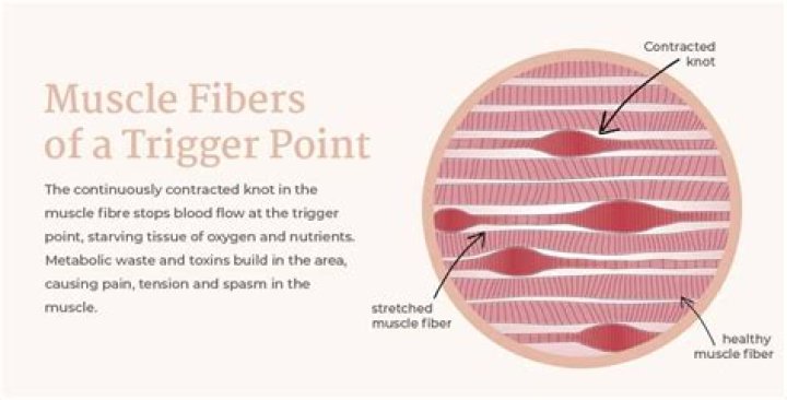 How knots form in muscles?