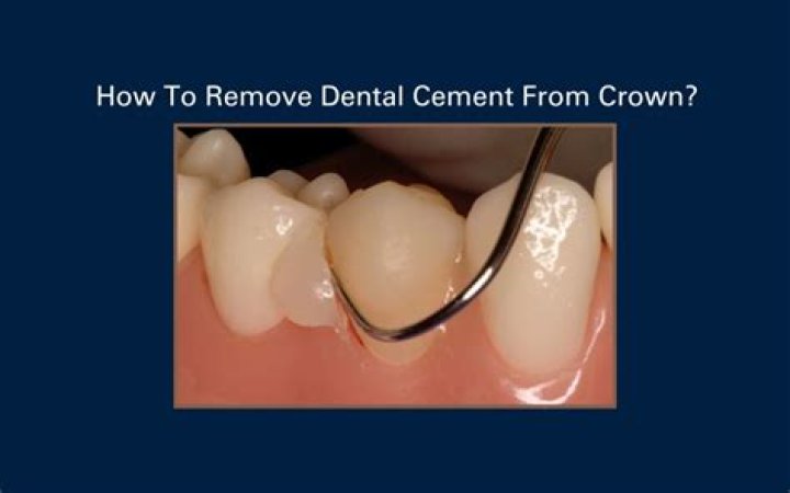 How long does it take to recement a crown?