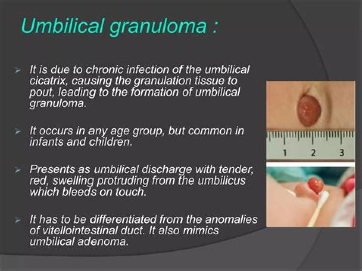 How long for umbilical granuloma to heal?