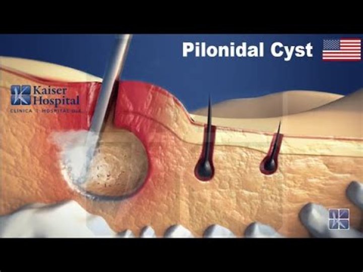 How long pilonidal cyst to heal?