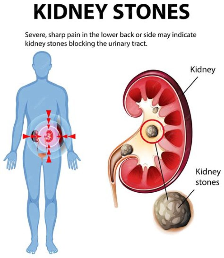 How long to pass a kidney stone?