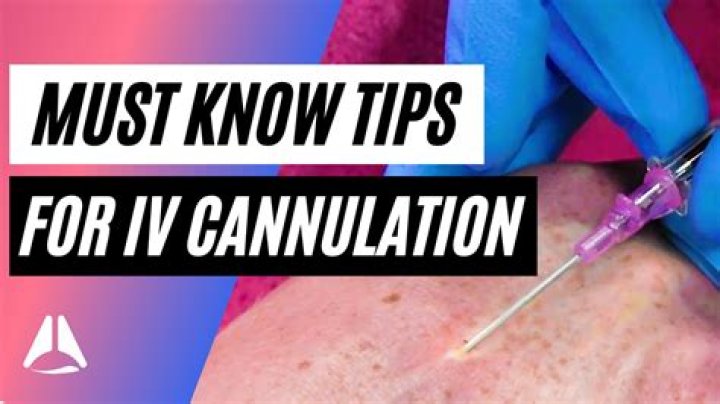 How many cannulation attempts?
