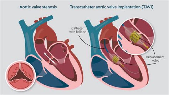 How much is a tavi procedure?