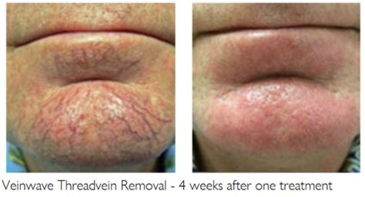 How much is thread vein removal?