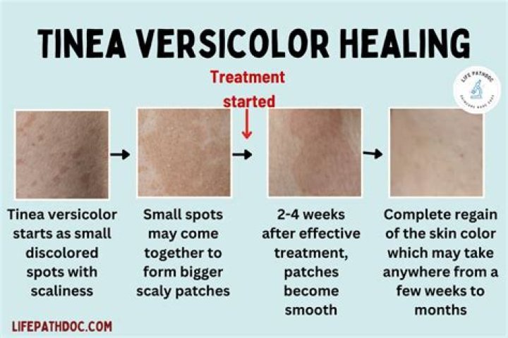 How tinea versicolor start?