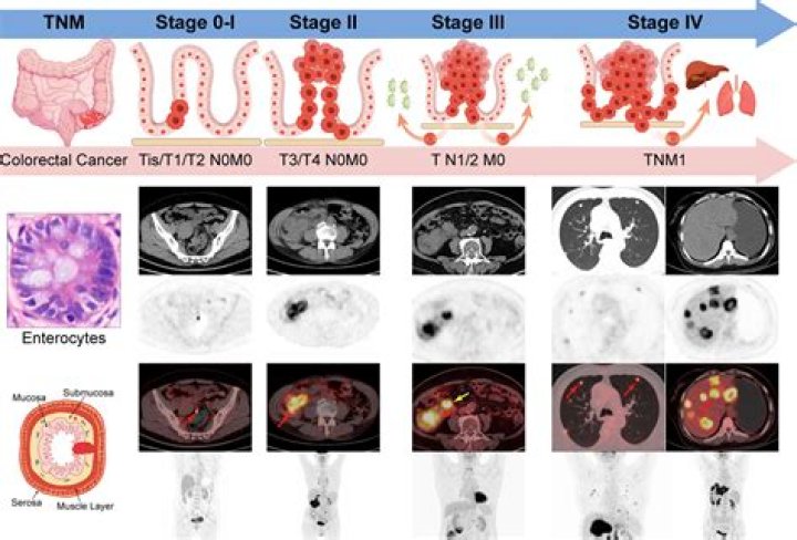 How to code carcinomatosis in icd 10?