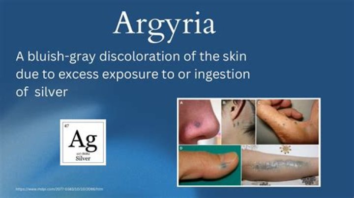 How to cure argyria?
