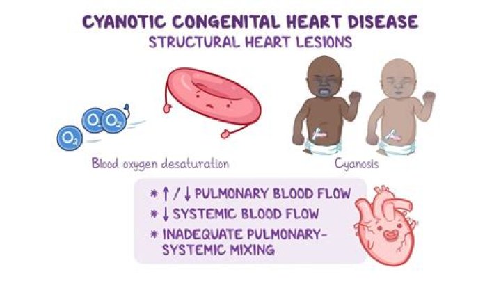 How to cure cyanotic heart disease?