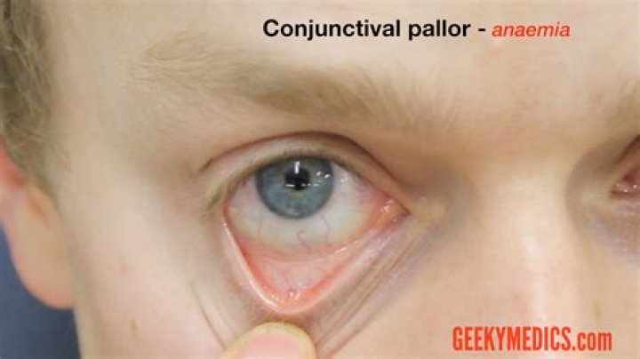 How to examine pallor?