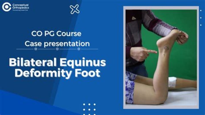 How to fix equinus?