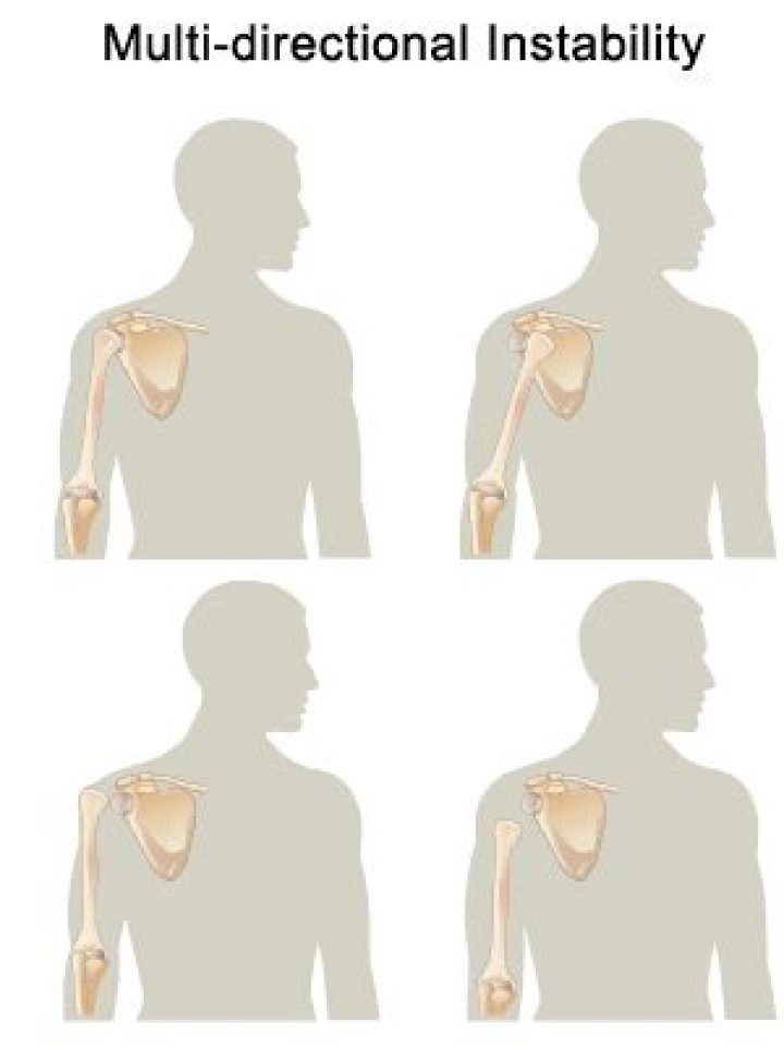How to fix multidirectional instability?