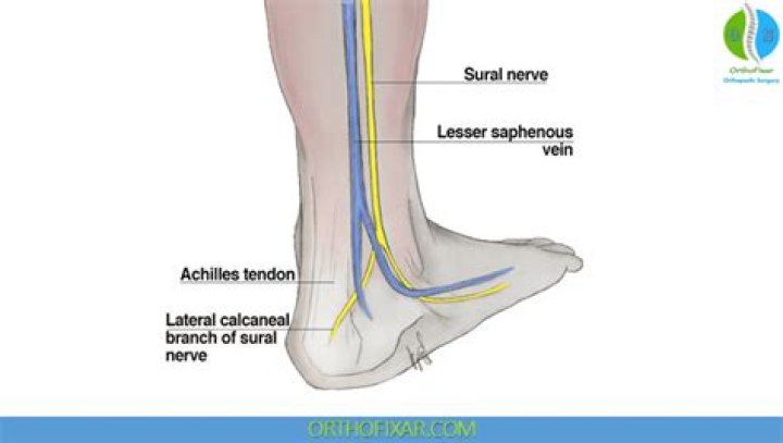 How to fix sural nerve entrapment?