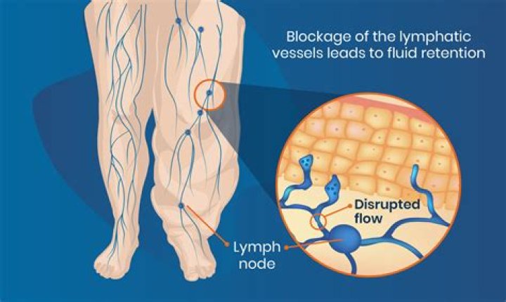 How to get lymphorrhea?