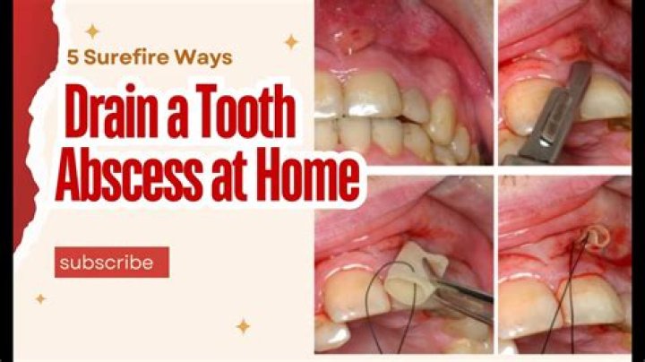 How to get rid of a tooth abscess?