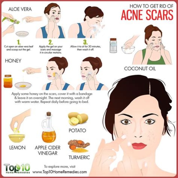 How to get rid of acne?
