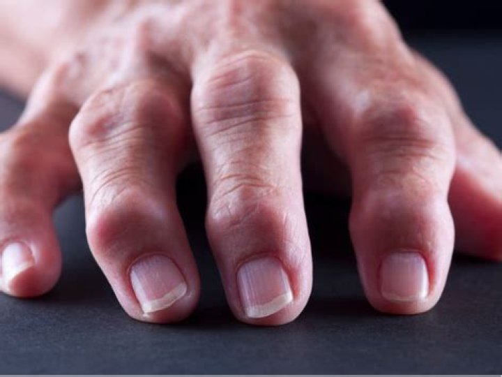 How to get rid of arthritis bumps on fingers?