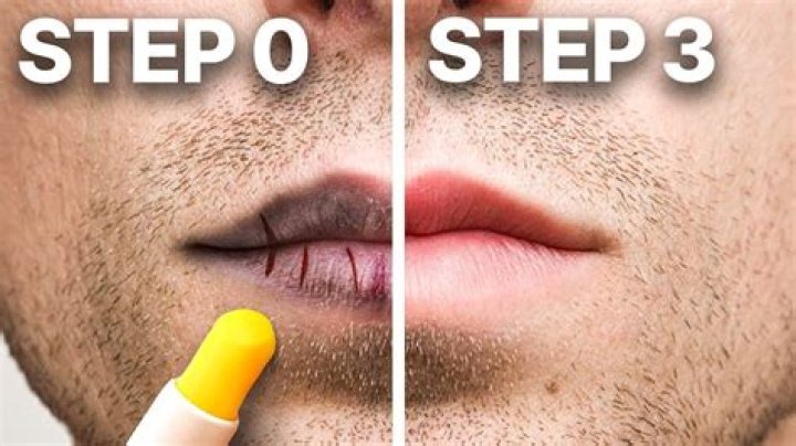 How to get rid of chapped nose?