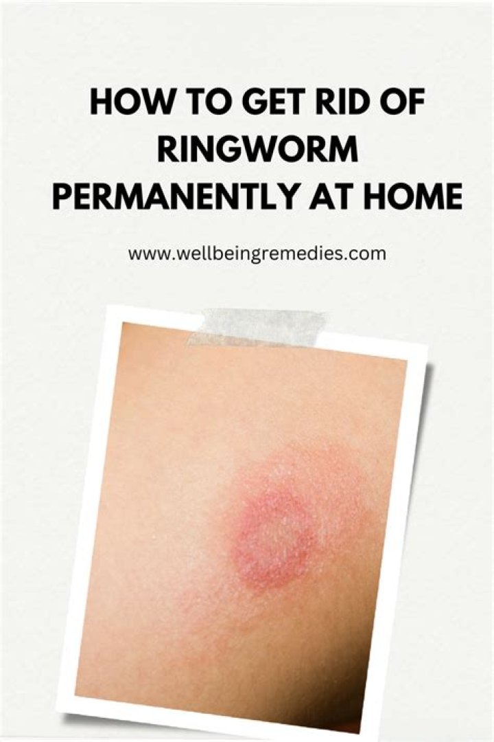 How to get rid of ringworm?
