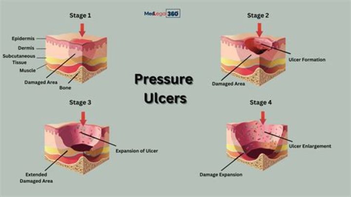 How to heal hunner's ulcers?