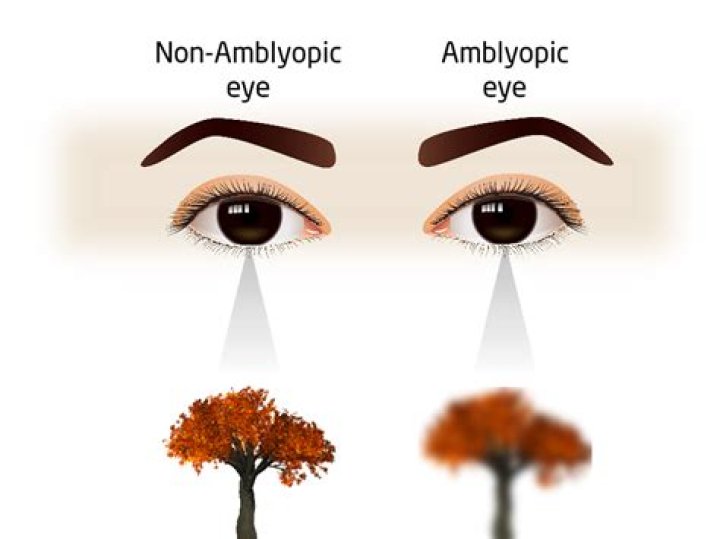 How to manage anisometropia?