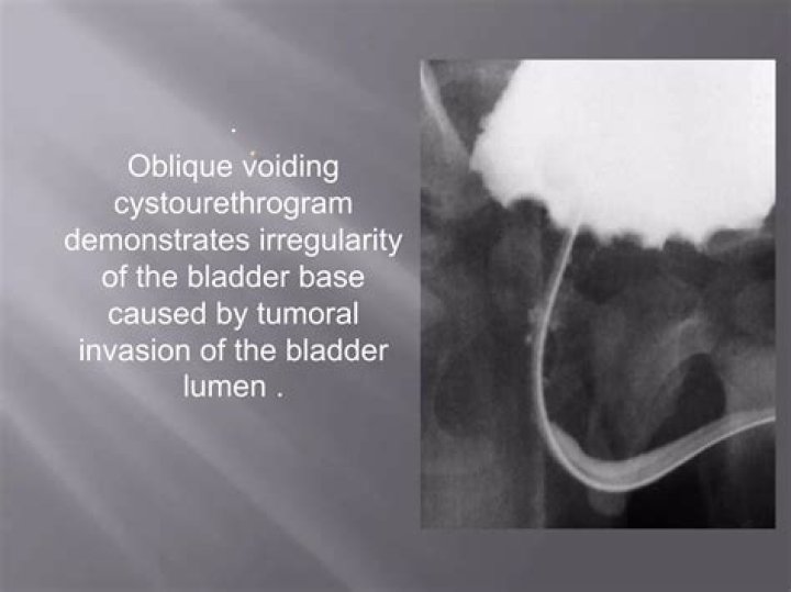 How to perform micturating cystourethrogram?