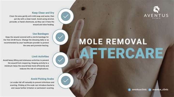 How to remove a mole off your head?