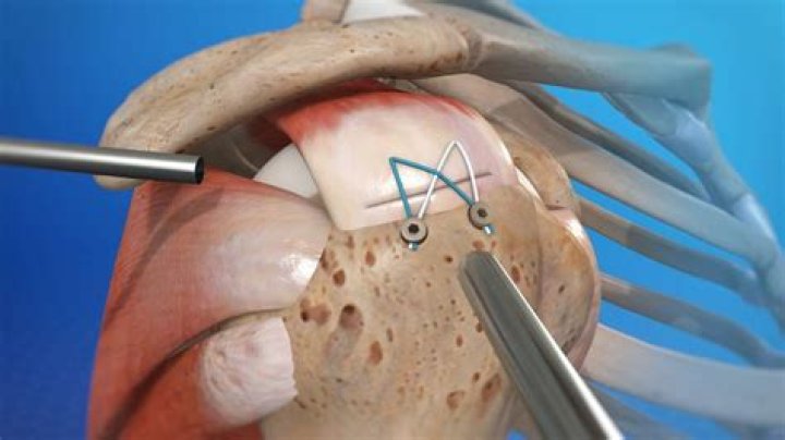 How to repair supraspinatus tendon tear?