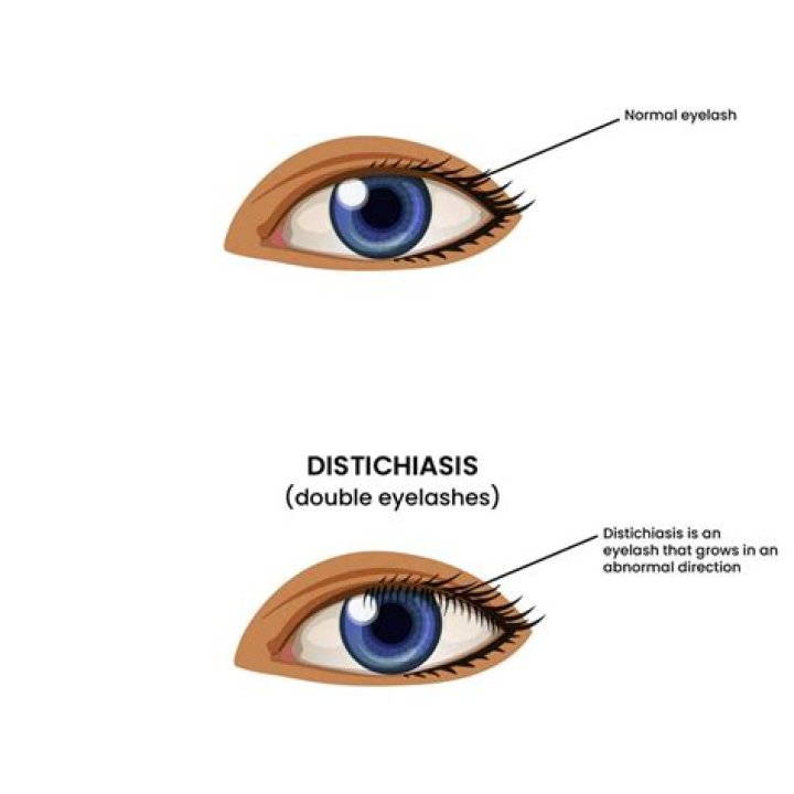 How to tell if you have distichiasis?