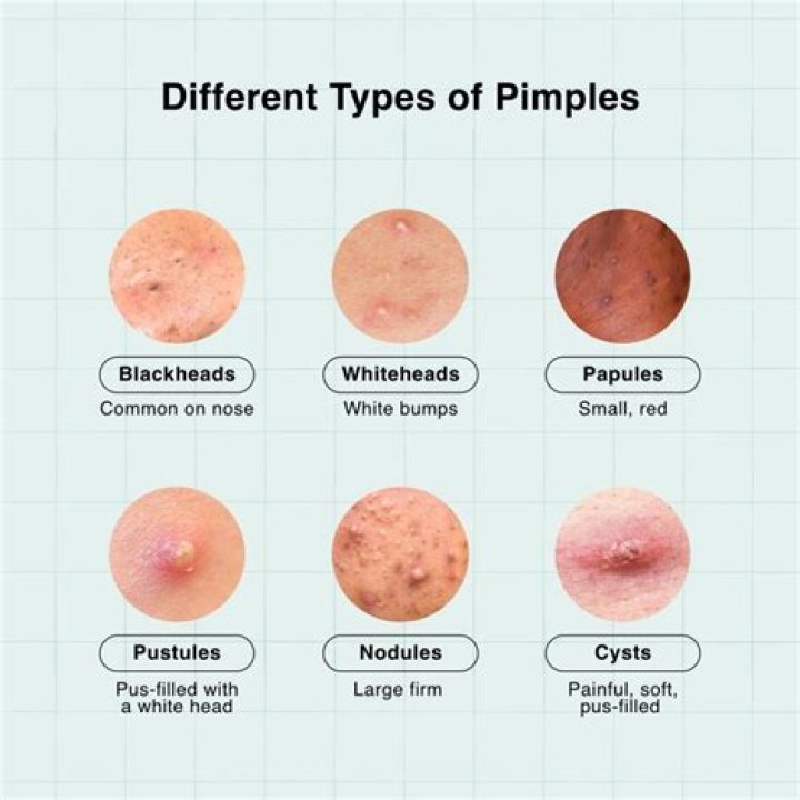 How to treat a pimple that hasn't surfaced?