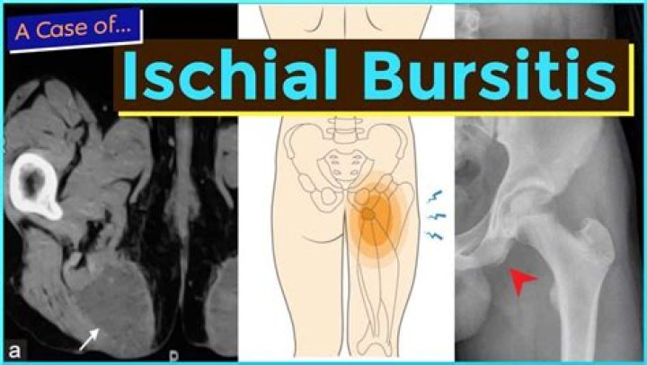 How to treat ischial bursitis?