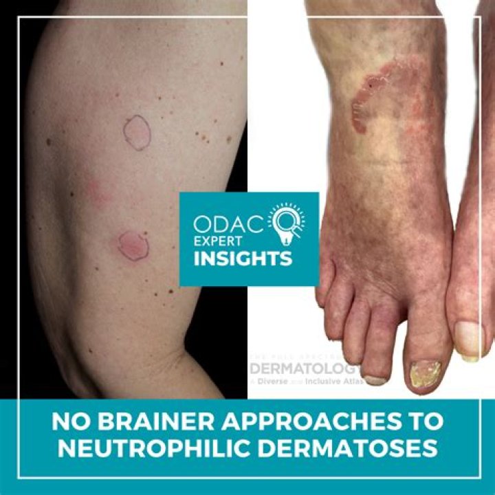 How to treat neutrophilic dermatoses?