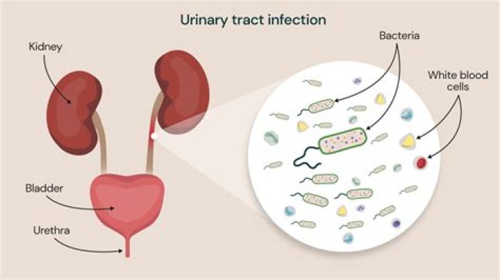 How u get a urine infection?