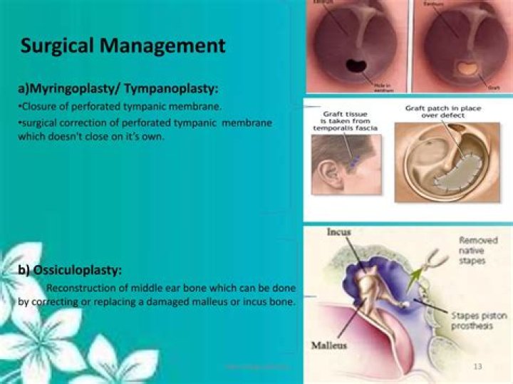 In a myringoplasty the surgical procedure is a(n)?