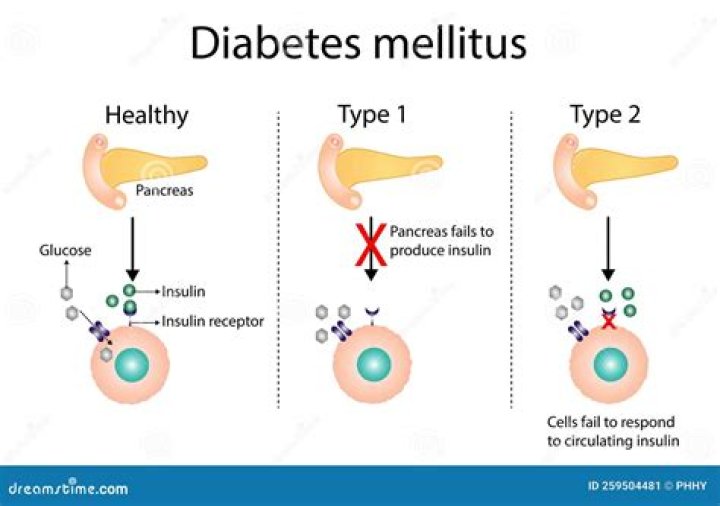 In untreated type i diabetes mellitus?