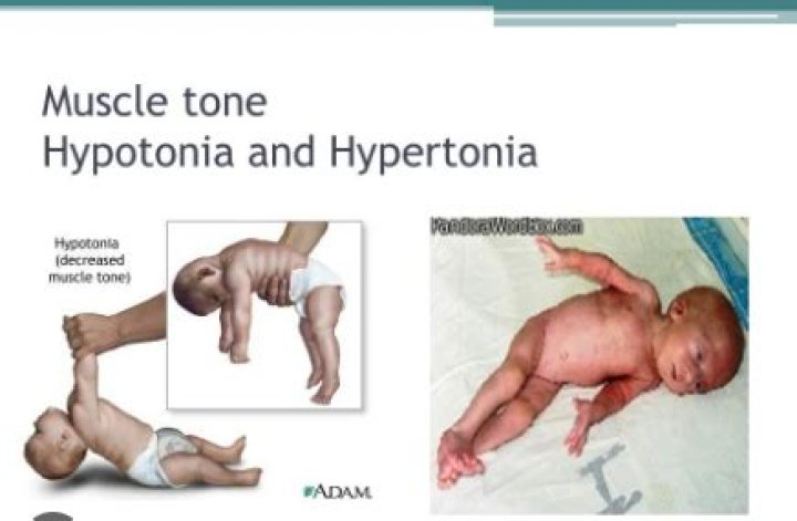 Increase in tone hypertonia?