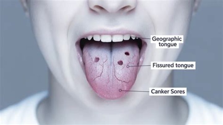 Is a fissured tongue bad?